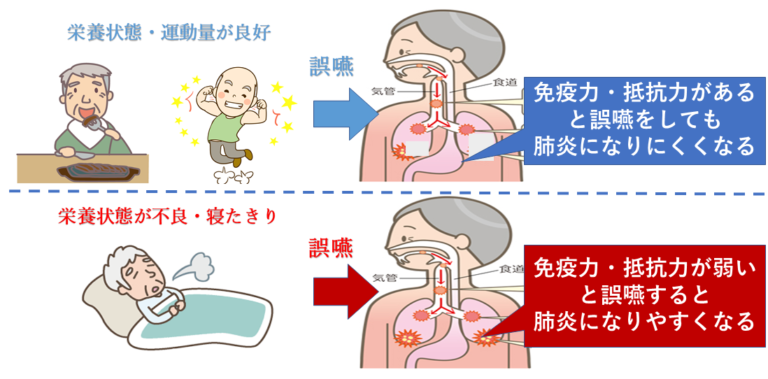 誤嚥性肺炎の予防とは 八尾市 にじリハ訪問看護ステーション